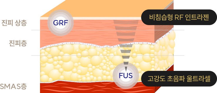 시술원리 이미지